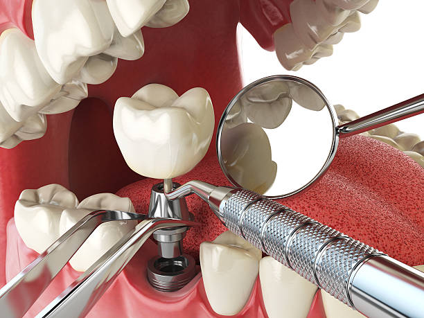 Best Emergency Wisdom Teeth Removal in Fort Loramie, OH